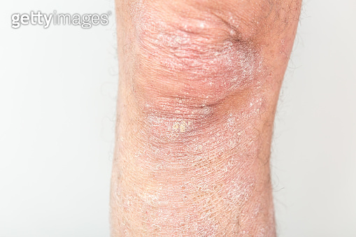 Acute psoriasis on a man’s lap is an incurable autoimmune ...