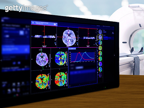 Brain Perfusion or CT scan of Blood flow in the brain 3d rendering ...