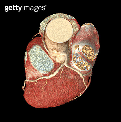 Top view of CTA Coronary artery 3D rendering image isolated o black ...