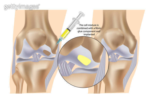 Tibia Meniscus Injection Stem cell therapy ( Injections) for repair of knee cartilage ...