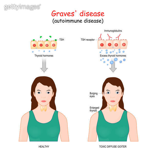 Graves' disease. toxic diffuse goiter is an autoimmune disease that