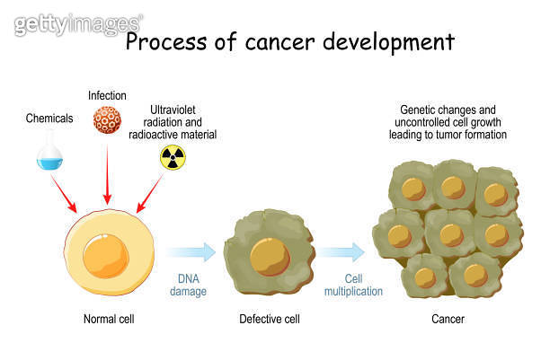 process of cancer cell development (1253904733) 일러스트, 무료 일러스트 - 게티이미지뱅크