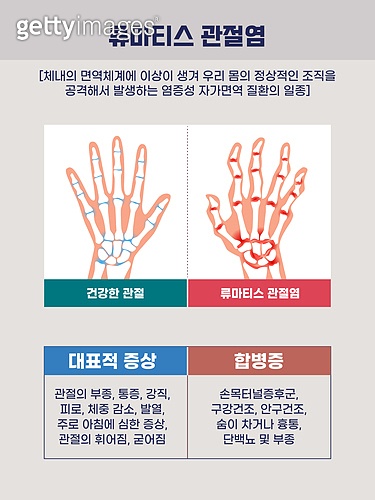 질병 (건강이상), 관절염, 류머티즘 (염증), 염증, 지골 (사람뼈) 이미지 (jv13104040) - 게티이미지뱅크