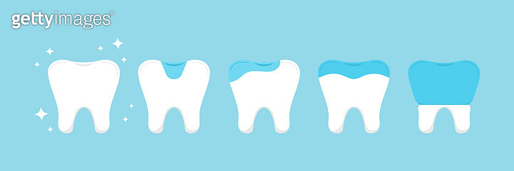 Tooth dental inlay, onlay, overlay and crown treatment set. (1360234717 ...