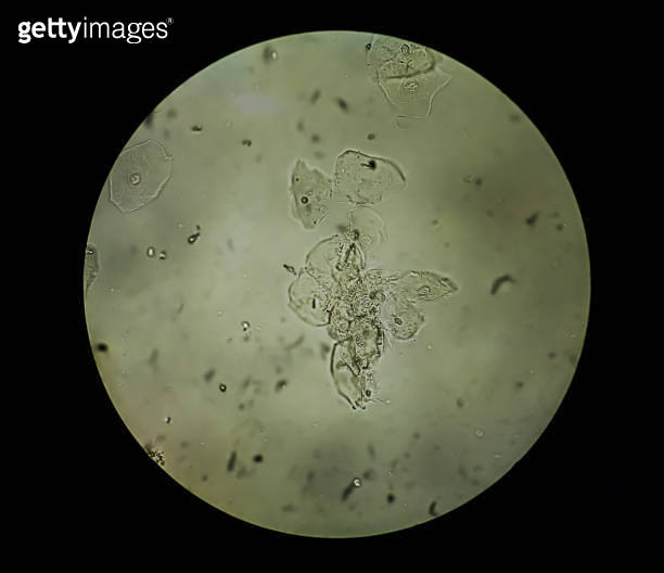 Urine specimen microscopic show epithelial cells. 이미지 (1355318612) - 게티 ...