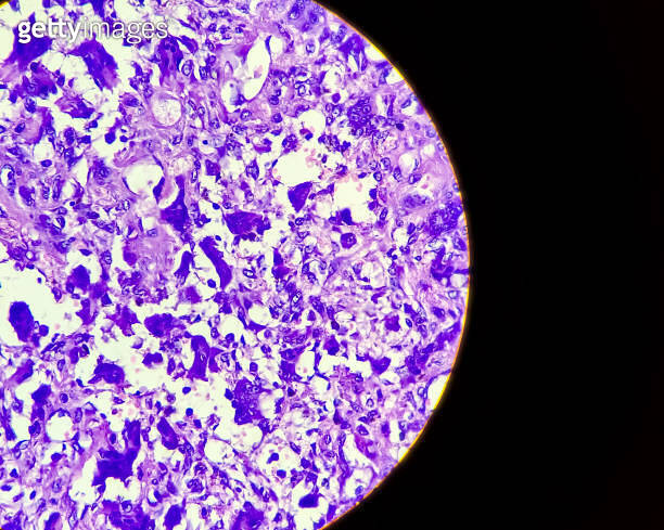 Osteoclast like giant cells. Light micrograph of a giant cell tumour of ...