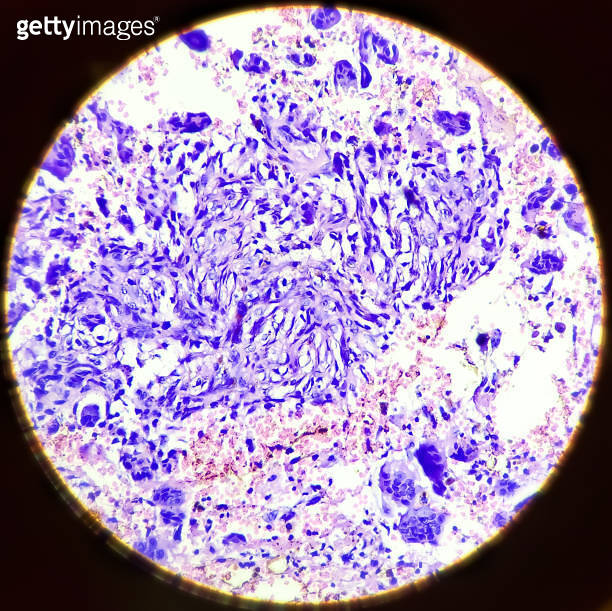 Osteoclast like giant cells. Light micrograph of a giant cell tumour of ...