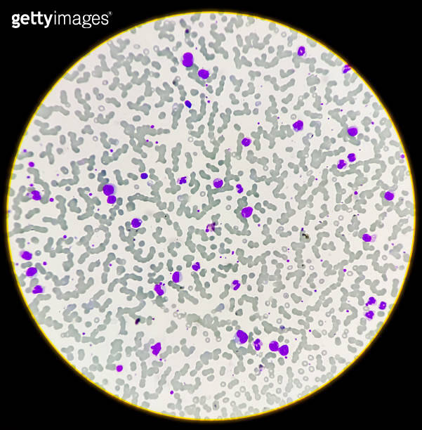 Leuco-erythroblastic anaemia and Chronic myelomonocytic leukemia (CMML ...