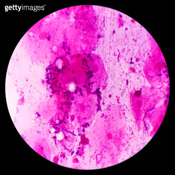Gram Stain Gram Positive Cocci Gram Positive Diplococci Bacteria Gram stain gram positive cocci gram positive diplococci bacteria