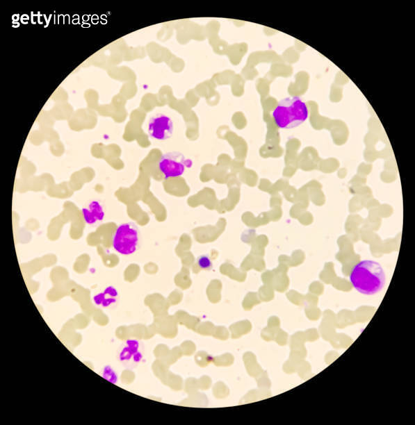 Leuco-erythroblastic anaemia and Chronic myelomonocytic leukemia (CMML ...