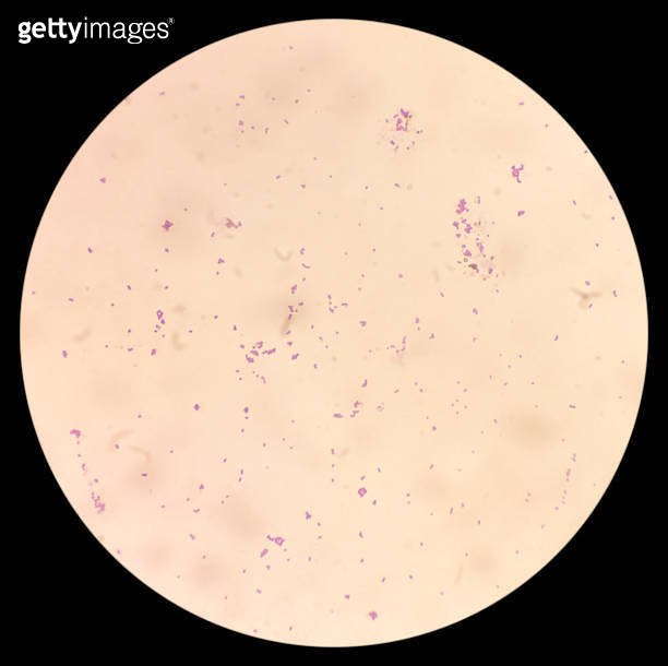 Gram positive cocci bacteria, Gram positive diplococci in urine sample