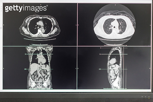 Computer Screen Showing MRI, CT Image Scan of the Brain. CT whole ...