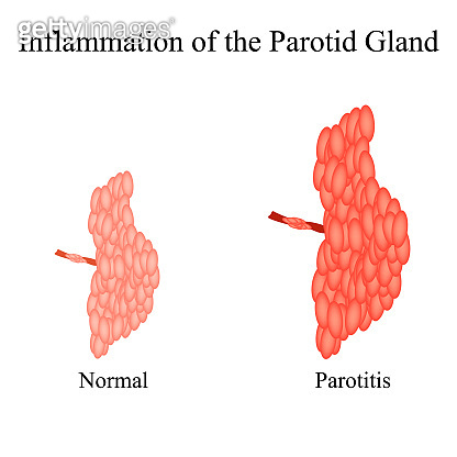 Inflammation of the parotid gland.The structure of the parotid salivary ...