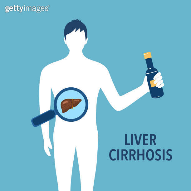 Drinking beer or alcohol beverage can damage liver. Liver cirrhosis