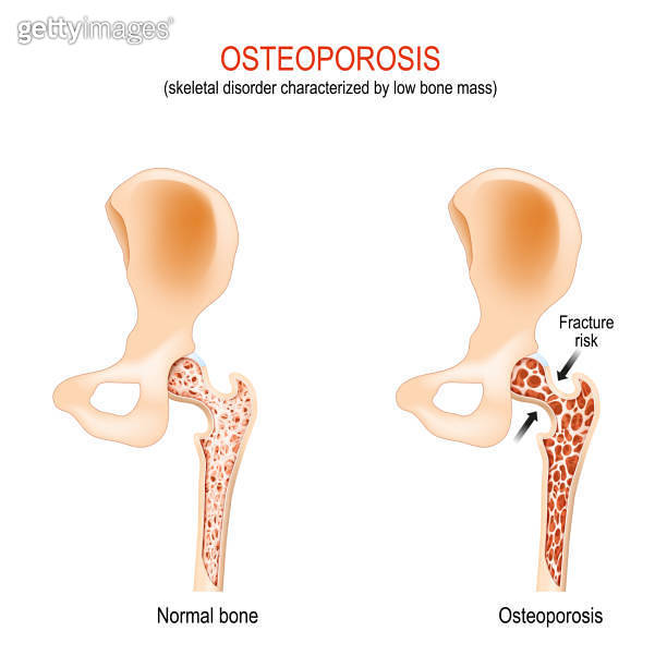Normal Back Bone Osteoporosis. normal hip joint and bone with low bone mass. (1336533461 ...