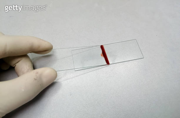 Smear drawing of blood by glass slide, peripheral blood smear. CBC ...