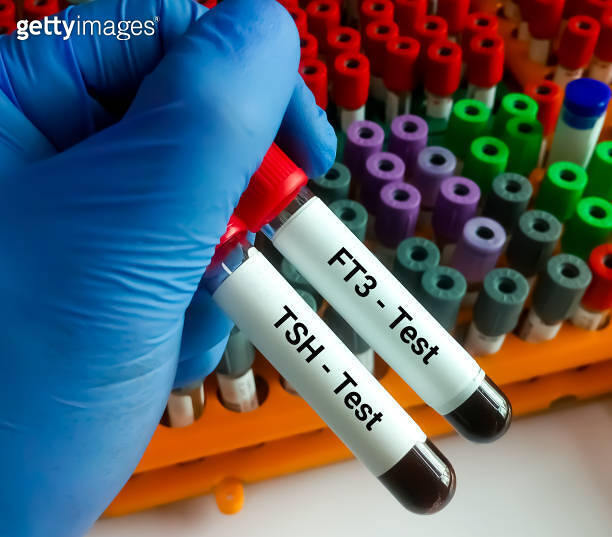 Blood sample in test tubes for TSH, FT3 test. Diagnosis of