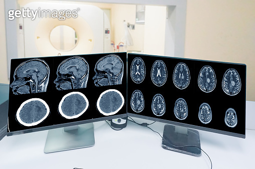 Close up CT-scan control room and showing brain image meningioma in ...