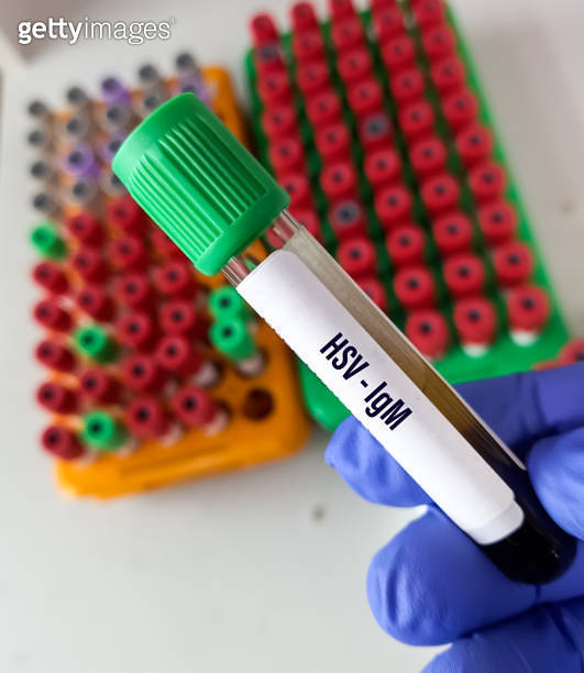 Close view of technician hold a blood sample of HSV(herpes simplex