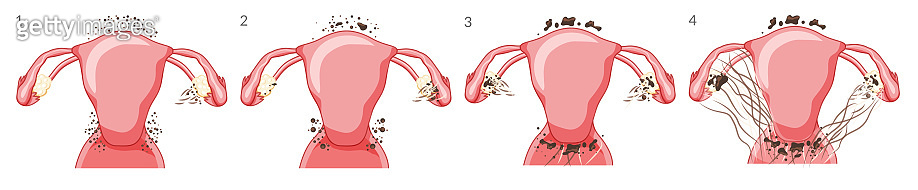Set of Endometriosis 4 stages Female reproductive system pain cancer ...
