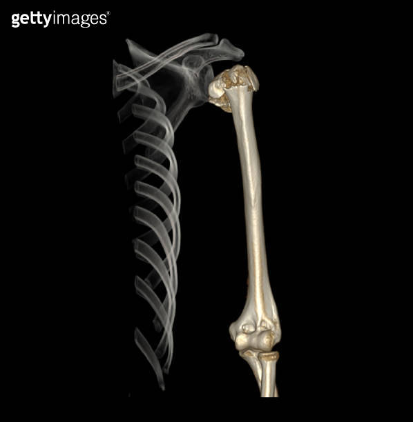 CT scan of shoulder joint and humerus bone or arm. 이미지 (1421270499 ...