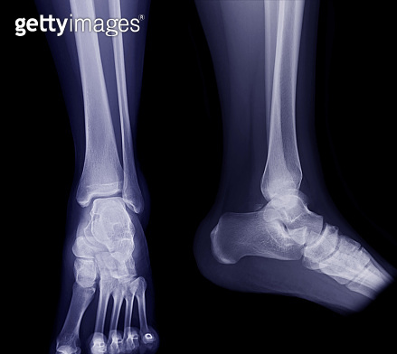 X-ray image of ankle joint AP and Lateral view for diagnosis fracture ...