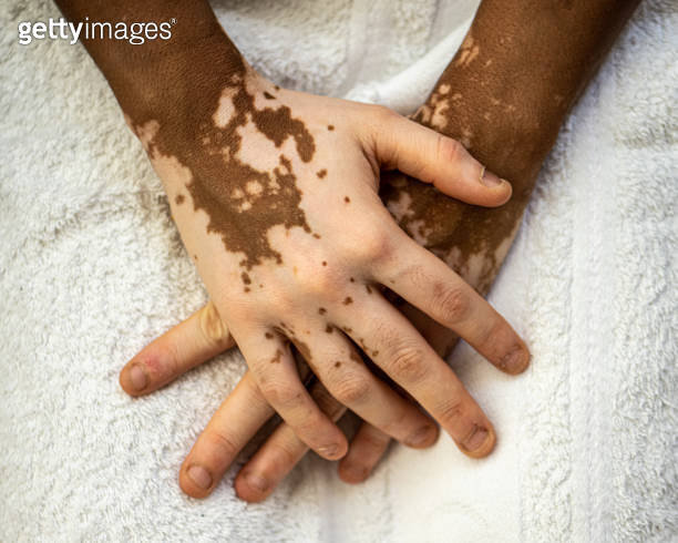 Melatonin Skin Rash Details of skin tones on the hands of a young African woman with skin ...