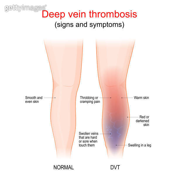 deep vein thrombosis. Healthy leg, and leg with DVT. Sign and symptoms ...