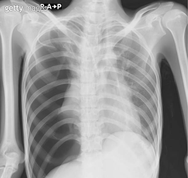 Pneumothorax chest x ray 이미지 (1372747037) 게티이미지뱅크