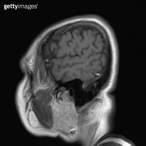 normal brain MRI images 이미지 (1430508434) - 게티이미지뱅크