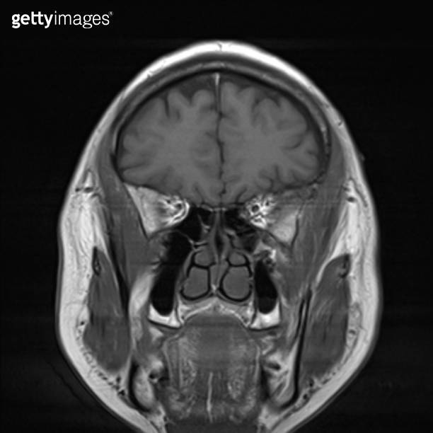 normal brain MRI images 이미지 (1430512465) - 게티이미지뱅크