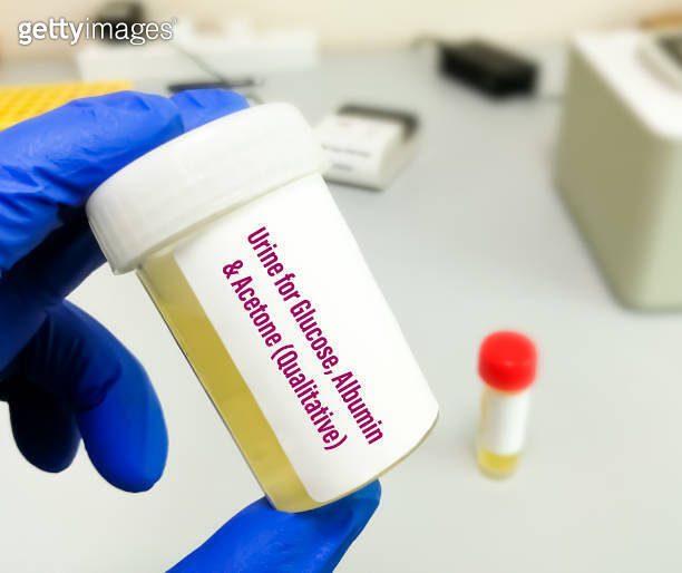 Urine sample for urinary Glucose, Albumin and Acetone level