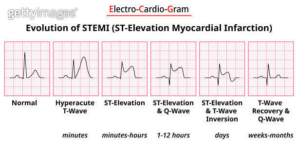 Evolution of STEMI (ST-Elecation Myocardial Infarction) (1503678878 ...