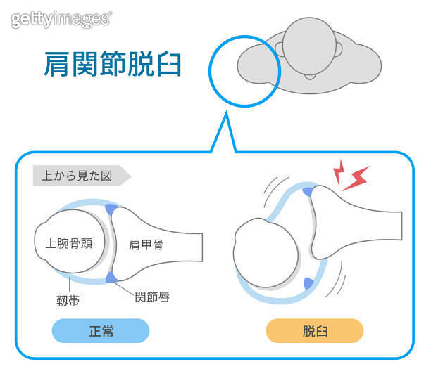 Mechanism and causes of shoulder joint dislocation from above ...
