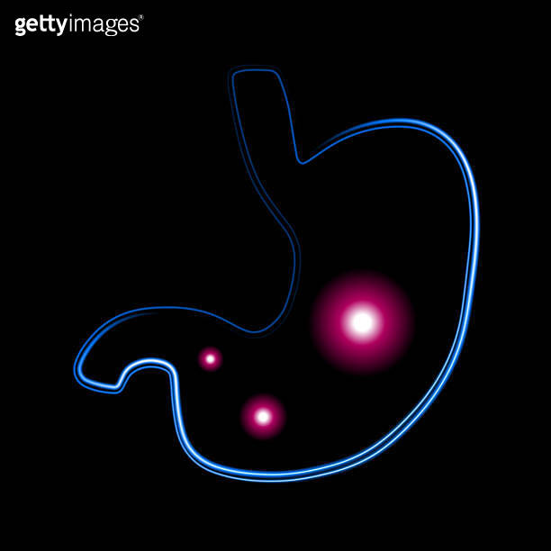 Gas in the stomach. 이미지 (1487918443) 게티이미지뱅크