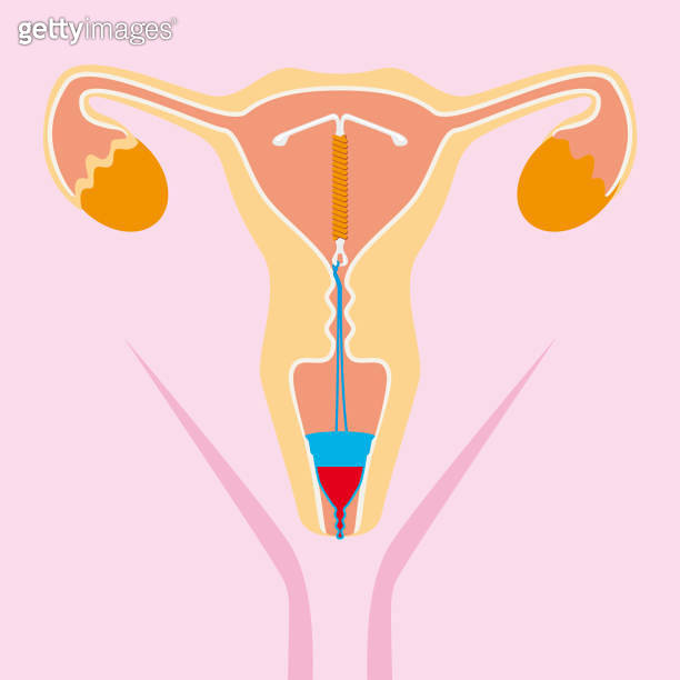 Copper intrauterine device (IUD) and menstrual cup 이미지 (1484653484