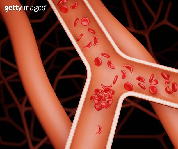 Sickling of red blood cells can increase the risk of developing blood clots 이미지 (1495514782
