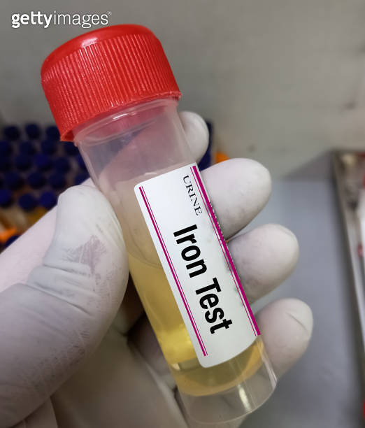 Urine sample for Urinary Iron Level test, to diagnose of iron over load