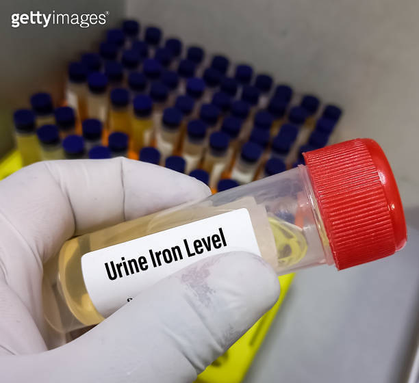 Urine sample for Urinary Iron Level test, to diagnose of iron over load