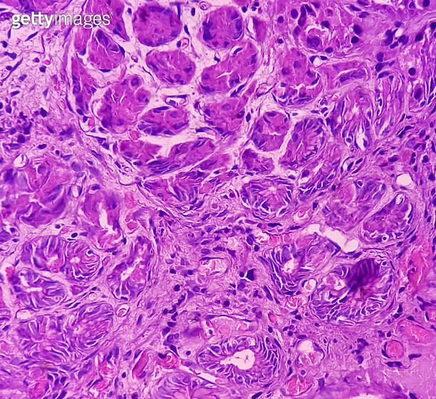 Gastric body tissue (endoscopic biopsy) Section show gastric mucosa