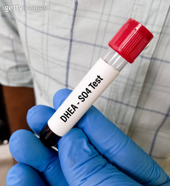 Test Tube with blood sample for DHEA SO4(dehydroepiandrosterone sulfate