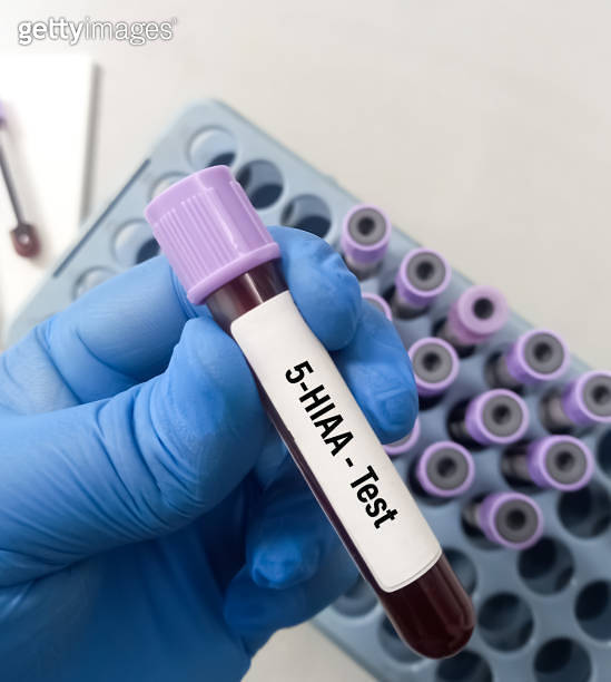 Blood sample for 5HIAA (5Hydroxyindoleacetic acid) test. 이미지
