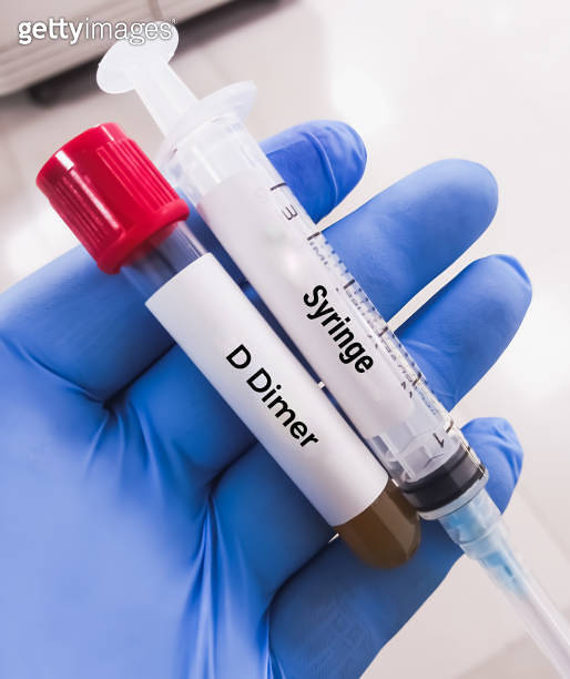 DDimer test. Corona patient monitoring test in ICU. 이미지 (1817750157