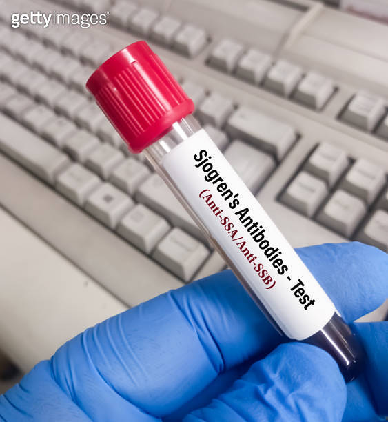 Blood sample for Sjogren's antibody panel test. Sjogren SSA, SSB. Anti