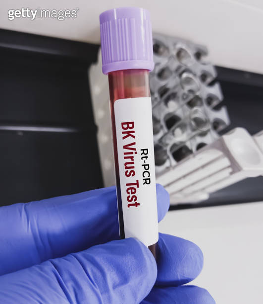 Blood sample for Real time PCR BK virus test, 이미지 (1746571007) 게티이미지뱅크