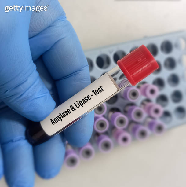 Biochemist or Lab Technologist holds Blood sample for Amylase and