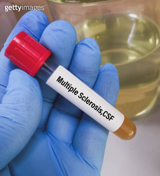 CSF sample for Multiple Sclerosis testing. Multiple Sclerosis disease