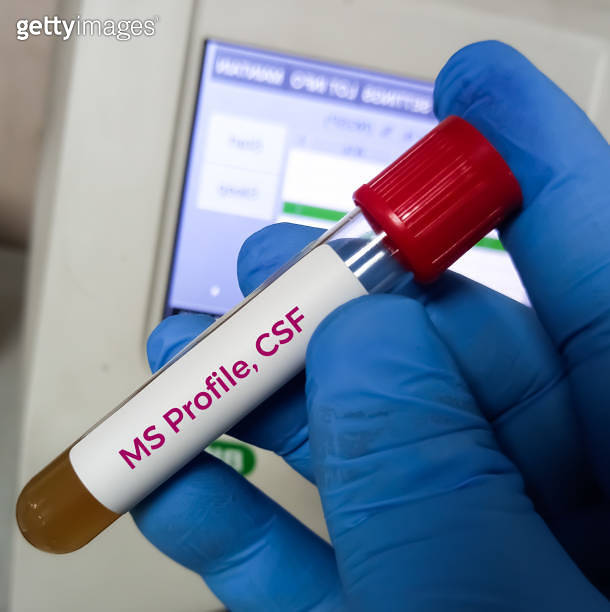 CSF sample for Multiple Sclerosis testing. Multiple Sclerosis disease