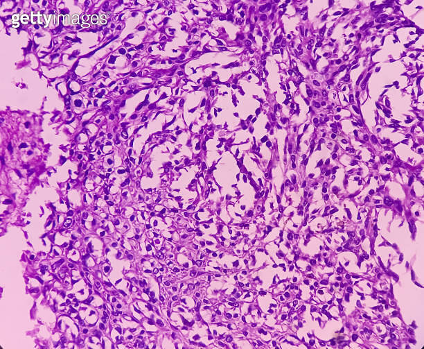 Nipple (biopsy) Invasive squamous cell carcinoma of nipple