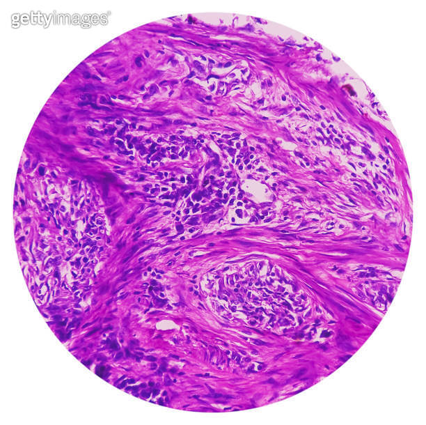 Nipple (biopsy) Invasive squamous cell carcinoma of nipple